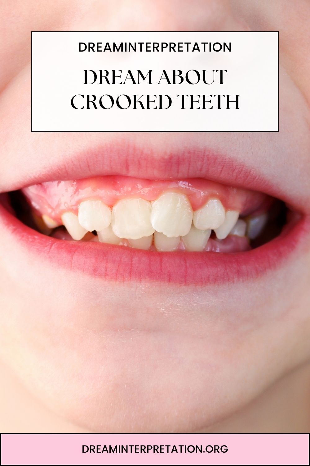 Dream About Crooked Teeth pin 1